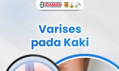 Kenali Varises Sejak Dini, Ini Penyebab, Gejala hingga Cara Penanganannya